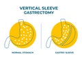 Laparoscopic Sleeve Gastrectomy, Vertical Gastrectomy, Weight loss surgery Vector Illustration of Stomach reduction surgery Royalty Free Stock Photo