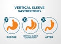 Laparoscopic Sleeve Gastrectomy, Vertical Gastrectomy, Weight loss surgery Vector Illustration of Stomach reduction surgery Royalty Free Stock Photo