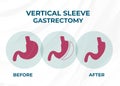 Laparoscopic Sleeve Gastrectomy, Vertical Gastrectomy, Weight loss surgery Vector Illustration of Stomach reduction surgery