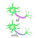 The destruction of the myelin sheath on the axon. Damaged myelin. Neuron affected by multiple sclerosis. World Multiple