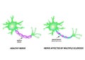 The destruction of the myelin sheath on the axon. Damaged myelin. Neuron affected by multiple sclerosis. World Multiple Royalty Free Stock Photo