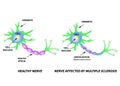 The destruction of the myelin sheath on the axon. Damaged myelin. Neuron affected by multiple sclerosis. World Multiple