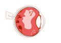 Destruction of the vitreous body Types of Floaters white blood cell deposits Fluid pockets vitreous strands Fragment of