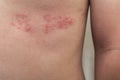 Detail of body skin with Herpes Zoster Shingles Royalty Free Stock Photo