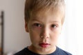 Detail of the boy with conjunctivitis red eyes