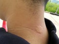 Man neck after bee stings