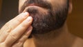 Detail of the man`s chin with seborrheic dermatitis in the beard area. Dry skin peels off and causes itching and dandruff