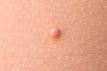 Detail of a molluscum contagiosum nodule produced by the Molluscipoxvirus virus on the skin of the abdomen of a child
