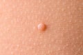 Detail of a molluscum contagiosum nodule produced by the Molluscipoxvirus virus on the skin of the abdomen of a child