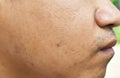 Pores and oily on surface young asian man face skin do not take care for a long time