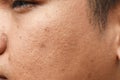 Pores and oily on surface young asian man face skin do not take care for a long time Royalty Free Stock Photo