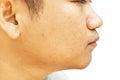 Pores and oily on surface young asian man face skin do not take care for a long time