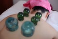 Detail of Woman with Acupuncture Cupping Treatment Royalty Free Stock Photo