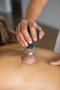 Detail of a woman therapist hands giving cupping treatment on back. Royalty Free Stock Photo