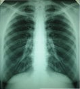 Detail of an x-ray of lungs