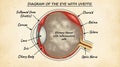 Anatomical illustration of human eye affected by uveitis condition Royalty Free Stock Photo