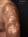 Vitiligo Skin Depigmentation on Arm Royalty Free Stock Photo