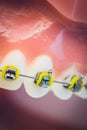 Detailed close up of dental denture or teeth on a table