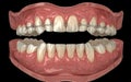 Detailed 3D model of human dentition with braces showcasing teeth alignment and occlusion in a clear view Royalty Free Stock Photo