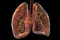 Human lungs affected by miliary tuberculosis, 3D illustration Royalty Free Stock Photo