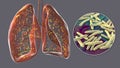 Human lungs affected by miliary tuberculosis, and close-up view of Mycobacterium tuberculosis, 3D illustration