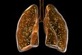 Human lungs affected by miliary tuberculosis, 3D illustration Royalty Free Stock Photo