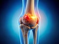 Detailed 3D Visualization of an Arthritic Knee Joint A Candid Medically Accurate Representation for Educational and Royalty Free Stock Photo