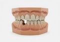 Detailed dental model with missing tooth isolated on white background Royalty Free Stock Photo