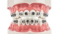 Detailed dental model with orthodontic braces displaying aligned teeth isolated on white background Royalty Free Stock Photo