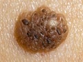 A detailed macro view of a mole with potential indications of malignant melanoma. Royalty Free Stock Photo