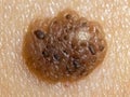 A detailed macro view of a mole with potential indications of malignant melanoma.