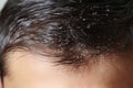 Detailed shot of dandruff on a mans close cropped hair