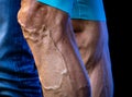 Cyclist legs with varicose and protruded veins