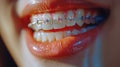Close Up of Persons Teeth With Braces Royalty Free Stock Photo