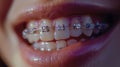 Close Up of Persons Teeth With Braces Royalty Free Stock Photo