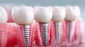 Detailed visualization of dental implants with ceramic crowns embedded in gum tissue highlighting the advanced restorative Royalty Free Stock Photo