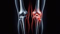 Detailed X-ray of healthy and arthritic knee joints. Royalty Free Stock Photo