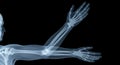 X-ray of Human Arms and Hands in Motion Royalty Free Stock Photo