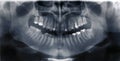 X-ray scan of human teeth