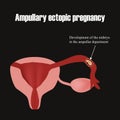 Development of the embryo in the ampullar department. Ectopic pregnancy. Infographics. Vector illustration Royalty Free Stock Photo