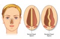 Deviated nasal septum