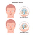 Deviated and normal nasal septum. Medical condition of crooked Royalty Free Stock Photo