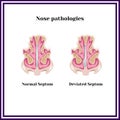 Deviated septum. Nasal pathology.