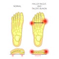 Deviation of the first and the fifth metatarsals transverse flat