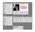 DEXA densitometry report of lumbar hip scan. Royalty Free Stock Photo