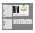 DEXA densitometry report of lumbar wrist joint scan Royalty Free Stock Photo