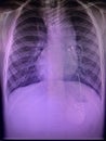 Dextrocardia film x-ray