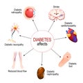 Diabetes Affects. Complications of diabetes mellitus Royalty Free Stock Photo