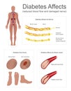 Diabetes affects the nerves and vessels. Royalty Free Stock Photo