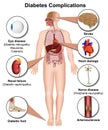 Diabetes complications and diseases medical 3d illustration on white background